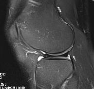 Discoid Meniscus MRI 3